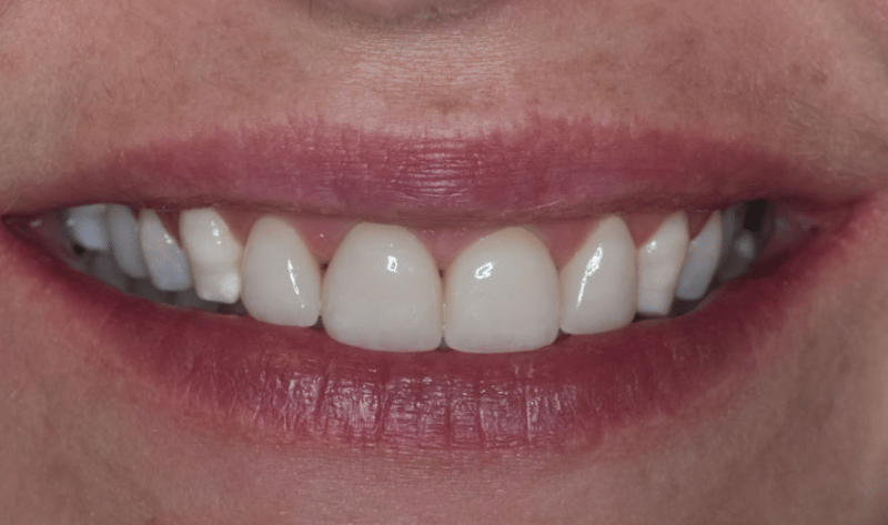 After - Rowtree Dental Care