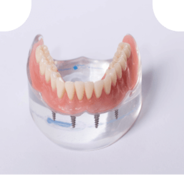  Dental Implant Rowtree Dental Care